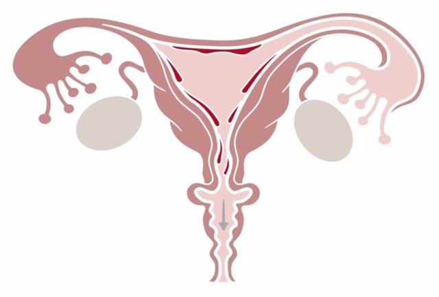 Ovarios poliquísticos