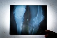 Las enfermedades reumáticas afectan a uno de cada cuatro españoles