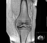 Condroitín sulfato es igual de eficaz que celecoxib en la reducción del dolor en artrosis de rodilla