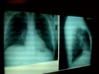 España registra cada año unos 100.000 hospitalizaciones y 8.000 muertes por neumonía