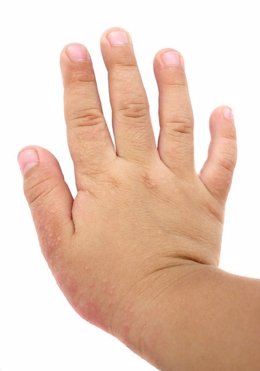 Dermatitis atópica en la mano de un niño.
