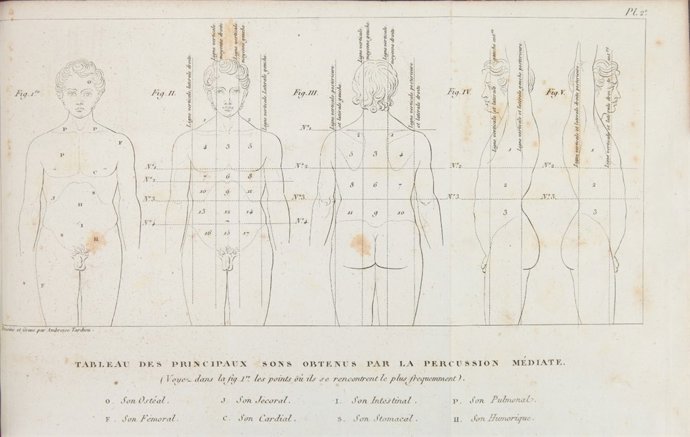 Esquema de Pierre Piorry sobre la percusión mediata. 