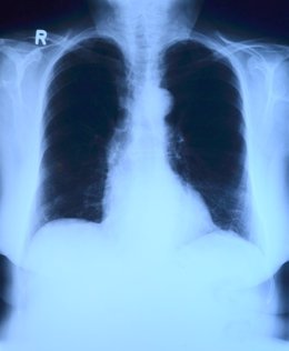 Pulmones, radiografía