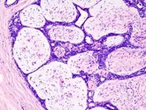 Foto: Una molécula del chile o la pimienta podría inhibir el crecimiento de las células del cáncer de mama