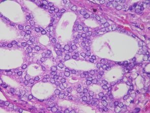 ¿Cuándo aparece el cáncer de próstata? (PIXABAY)