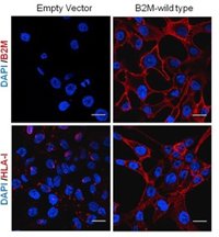 Descubren un gen que condiciona la respuesta a la inmunoterapia en cáncer de pulmón