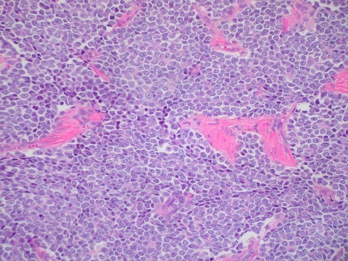 Sarcoma de Ewing