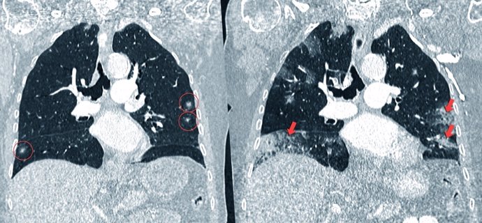Evolución del cáncer de pulmón