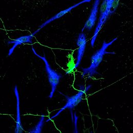 Las neuronas apoyan el crecimiento del cáncer en todo el cuerpo