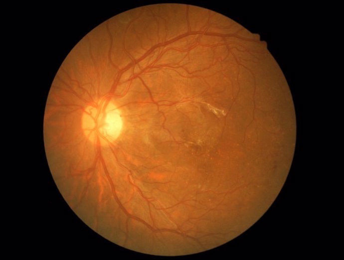 Glaucoma, ojo