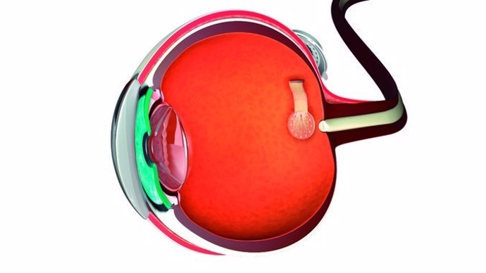 Esquema de prótesis de retina con estimuladores de grafeno