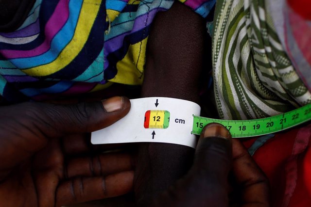 Un niño con signos de malnutrición en Sudán del Sur