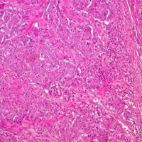 El estilo de vida determina más el riesgo de cáncer de colon y recto que la genética
