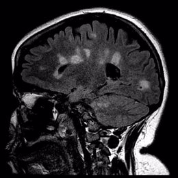 Cicatrización del cerebro en la esclerosis múltiple