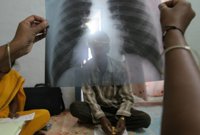 La tuberculosis mata a 5.000 personas cada día