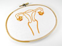 El 85% de los casos de cáncer de cérvix diagnosticados en el mundo son en países subdesarrollados