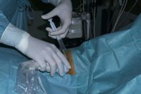 Tratan por primera vez en España la sequedad de la boca con células madre