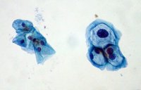 Nuevos avances en el diagnóstico precoz del cáncer orofaringeo