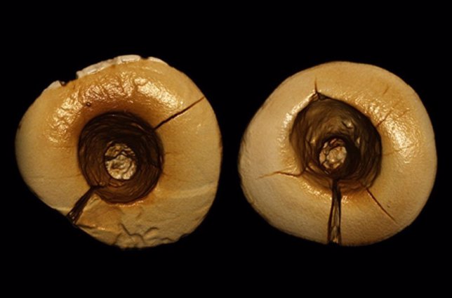 Escaneo de los dientes con bitumen