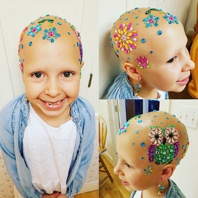 Niña de 7 años con alopecia