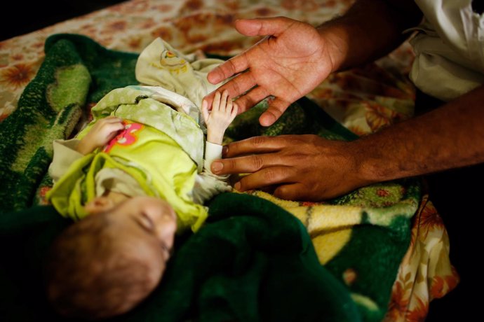 Un niño iraquí con síntomas de desnutrición en Mosul 