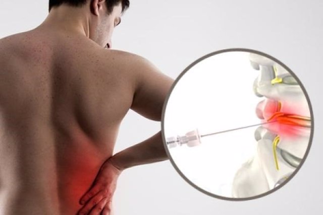 Nuevos Tratamientos Para Eliminar Hernias Discales Sin Cirugía 5868