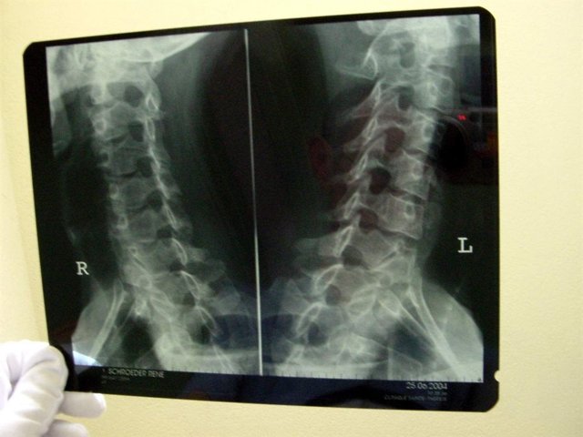 Esguince cervical