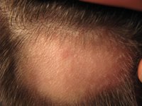 Sanidad avisa del riesgo para el hígado de usar en mujeres un fármaco para cáncer de próstata