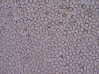 Los niveles de glóbulos blancos pueden predecir si los pacientes con cáncer de pulmón responderán a la inmunoterapia