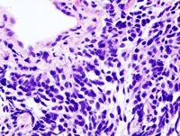La inmunoterapia puede beneficiar a algunos pacientes con cáncer de pulmón avanzado