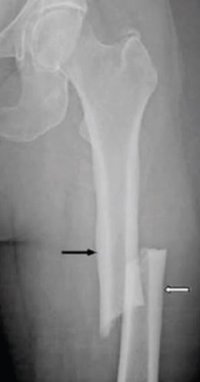 ¿Tratar algunas osteoporosis puede aumentar el riesgo de fracturas? Ya se sabe por qué