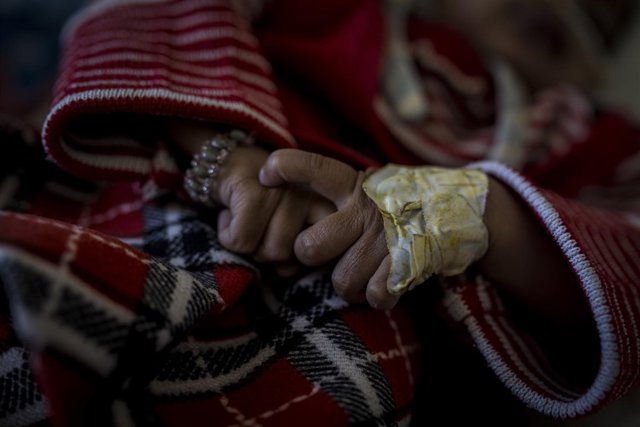 Mano de niña con desnutrición en Yemen