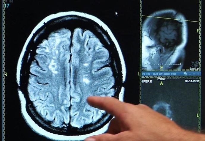 Ictus, derrame cerebral, cerebro