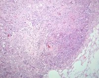 Expertos aseguran que el diagnóstico precoz y el uso de marcadores moleculares mejoren el abordaje del cáncer de pulmón