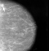 En marcha un ensayo clínico para tratar el cáncer de mama más agresivo