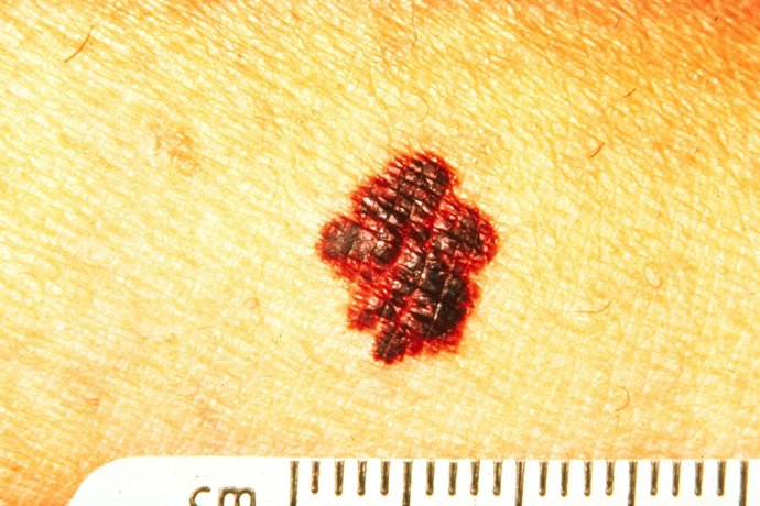 Melanoma