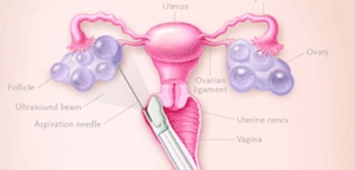 Ilustración de Donación de óvulos