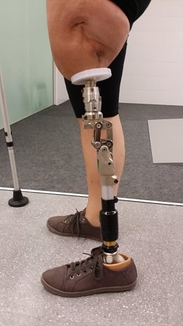 L'Hospital de Mataró connecta una pròtesi directament a un fèmur amputat