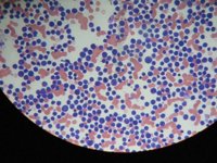 Diseñan una molécula eficaz en el tratamiento de leucemias