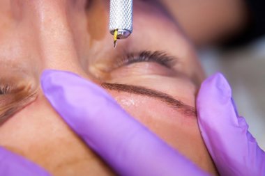 De la psoriasis en izraile