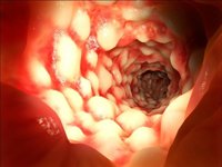 Un nuevo accesorio mejora el diagnóstico de lesiones precancerosas y cáncer de colon mediante las colonoscopias