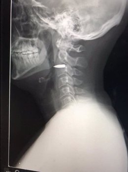 Radiografía de un periodista australiano que recibió un balazo en el cuello