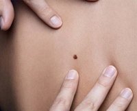 Sufrir cinco quemaduras antes de los 20 años aumenta el riesgo de melanoma un 80%, según expertos
