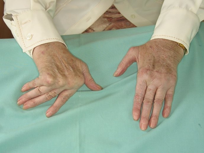 Deformidad simétrica con artritis reumatoide