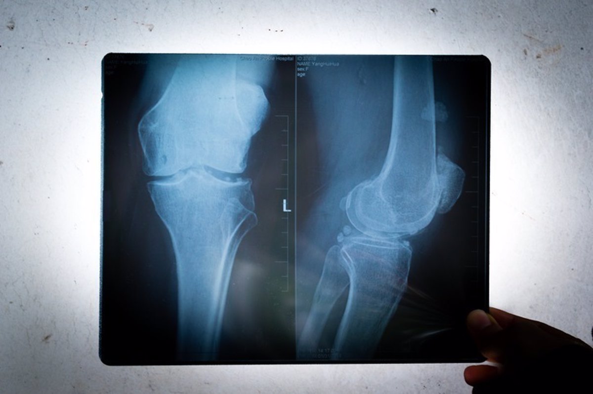 Artrosis de rodilla (Gonartrosis):Como aliviar el dolor de rodillas