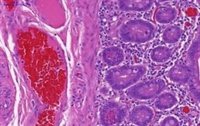 La terapia con inmunosupresores y fármacos antiTNF no aumenta el riesgo de cáncer en enfermedad inflamatoria intestinal