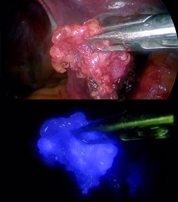 Radiación y fluorescencia: más posibilidades para detectar el ganglio centinela