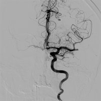El cáncer puede aumentar el riesgo de tromboembolismo arterial