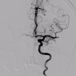 Imagen de arteria obstruida con trombo