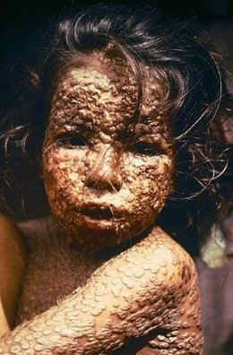 Niño con viruela